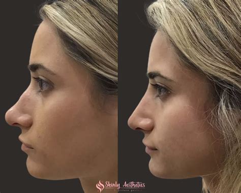 nose shaper results|Nose Shaping Solutions Overview: Cost, Recovery, .